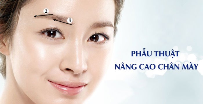 Quy trình phẫu thuật treo chân mày